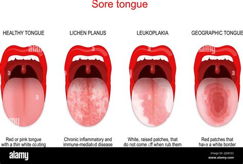 Sore or white tongue. comparison of healthy tongue and oral disease ...