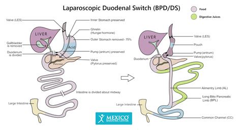 Duodenal Switch Surgery – The Procedure - Mexico Duodenal Switch