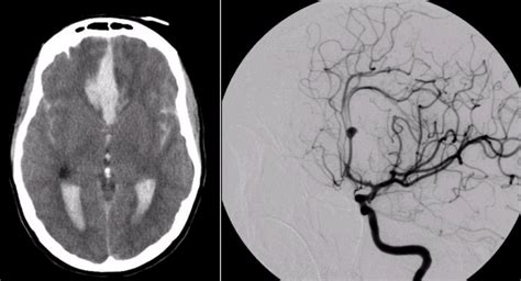 Cerebral Aneurysm Angiogram