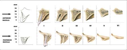 Edentulous alveolar ridge classification - heritagekera