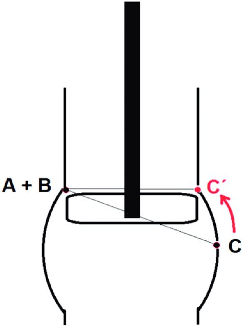 Diagram showing how to move up the third commissure in the bicuspid ...