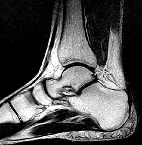 Medial Ankle Ligaments Mri