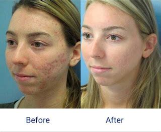 Laser Acne Scar Removal: Side Effects Of Laser Treatment For Acne Scars