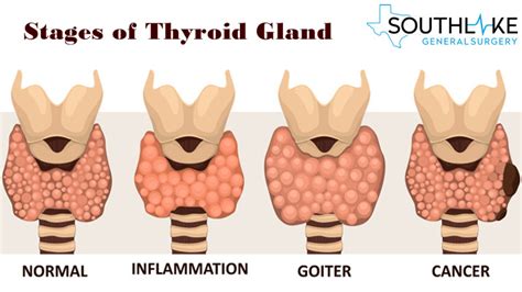 Need to Know Before go for Thyroid Surgery- Southlake General Surgery