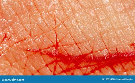 Close-up of Blood from a Wound on a Human Skin Stock Photo - Image of ...