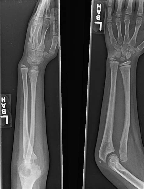 Congenital: Congenital Radial Head Dislocation