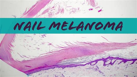 Acral Lentiginous Melanoma Histology