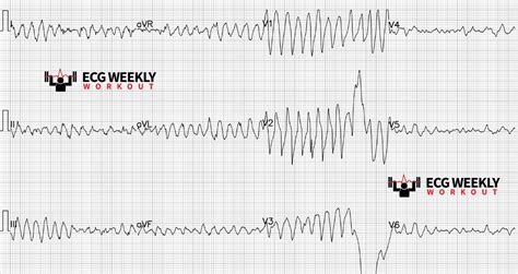 Potpourri Of Cases Generic Polymorphic Ventricular Tachycardia Vs