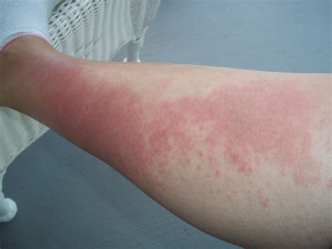 Raised Red Rash On Arms