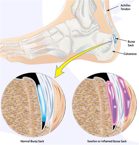 Achilles Bursitis Causes, Symptoms, Treatment