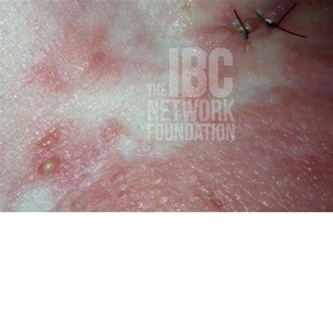 Pictures of Inflammatory Breast Cancer - The IBC Network Foundation