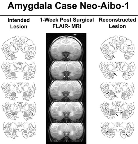 Intended amygdala damage is shown in gray on coronal sections through ...