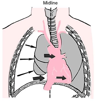 Mediastinal lymph node enlargement | definition of mediastinal lymph ...