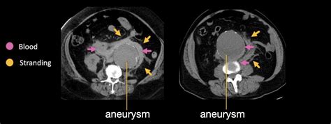 Abdominal CT: aortic aneurysm • LITFL • Radiology Library