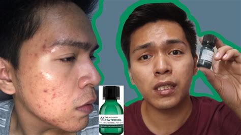 Tea Tree Oil Acne Before And After