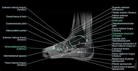 Anatomy of the foot and ankle - MRI | e-Anatomy