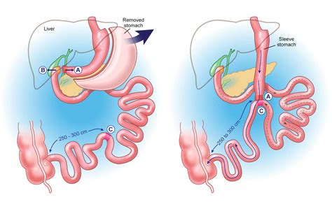 Duodenal Switch - IRAN Health Tourism Organizer - Iran Medical Tourism ...