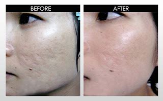 Acne Scars Before and After-7 Side Effects of Laser Acne Facial Need to ...