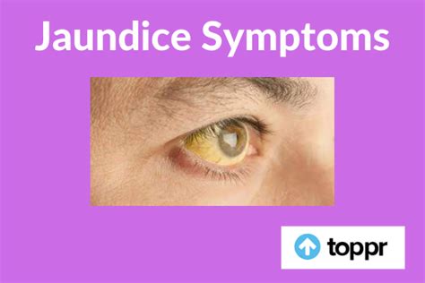 Jaundice Symptoms: Diagnosis, Causes, Treatment