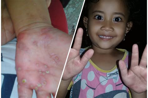 Penyakit scabies pada kulit - Lembaga Zakat Insan Madani Jambi