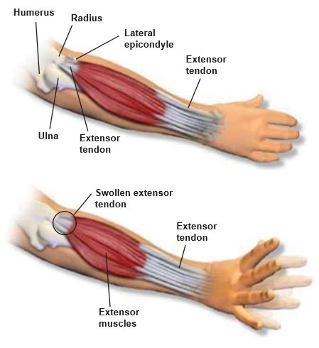 Lateral Epicondylitis | Central Coast Orthopedic Medical Group