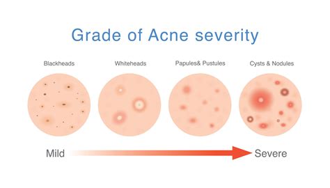 Accutane for Acne: What Are the Effects?