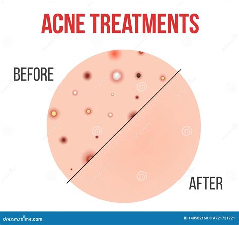 Creative Vector Illustration Types of Acne, Pimples, Skin Pores ...