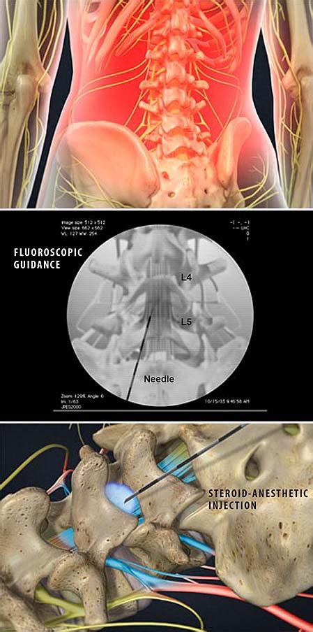 Lumbar Epidural Steroid Injection | Central Coast Orthopedic Medical Group