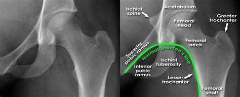 Hip Fracture