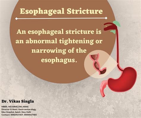 Esophageal Stricture - Gastron