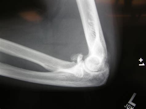 Radial Head Fractures-Hand Surgery-Wrist Surgery-Elbow Surgery