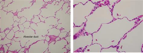 Emphysema Histology Labeled