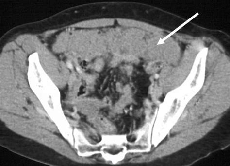 Pitfalls in pelvic CT imaging • healthcare-in-europe.com