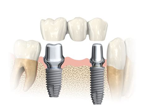 What Is An Implant Bridge? | Long Beach, NY | William J. Kobza, DDS