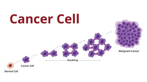 Stages of Cancer, Explained - The IBC Network Foundation