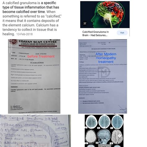 Calcified Granuloma Brain Tumour/ Lesion cured/dissolved & responded by ...