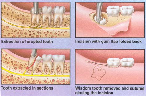 Nerve Pain: Nerve Pain Wisdom Tooth Removal