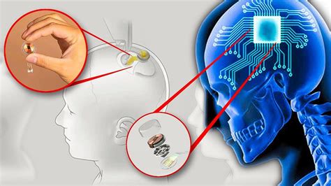 Musk Says, Neuralink to start human trial of brain implant