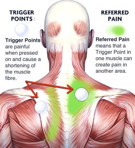 What is a muscle knot, why does it happen and what you can do to relieve it