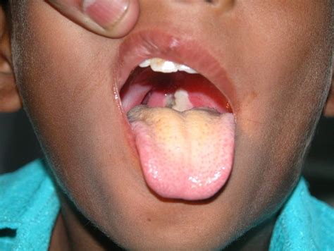 Diphtheria Symptoms, Causes, Diagnosis and Treatment - Natural Health News