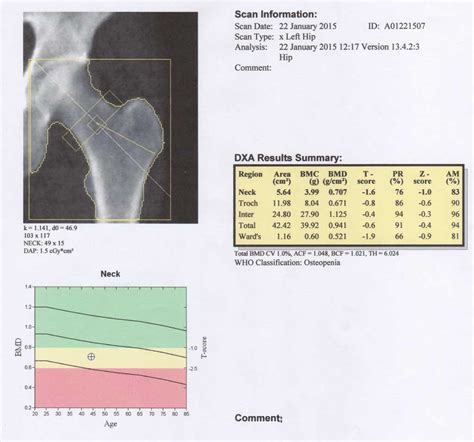 Ramp Test and DXA Scan – A Simple Life of Luxury