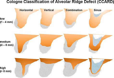 Cologne Classification of Alveolar Ridge Defects (CCARD) differentiates ...