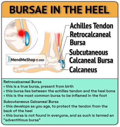 Achilles Bursitis Information & Recovery Treatments