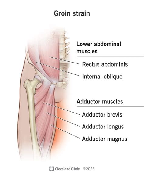 Groin Strain: Causes, Symptoms, Tests & Treatments