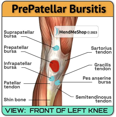 Prepatellar Bursitis: Causes Diagnosis Treatment