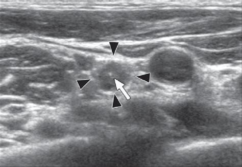 Swollen Lymph Nodes In Neck Ultrasound