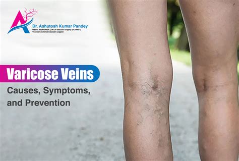 What is Varicose veins | Causes, Symptoms, and Prevention