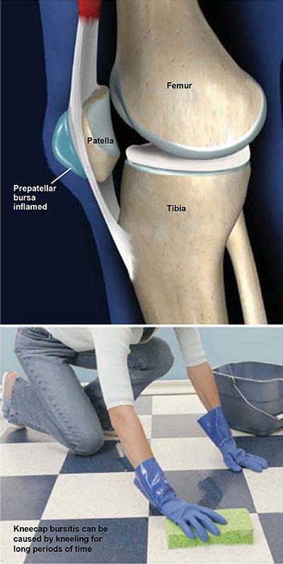 Prepatellar Bursitis (Kneecap Bursitis) | Central Coast Orthopedic ...