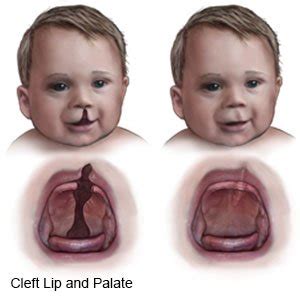 What Causes Cleft Lips In Babies | Lipstutorial.org