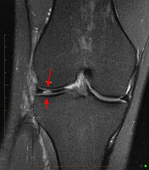 Torn Meniscus - Signs & Symptoms, Test, Diagnosis, Recovery, Treatment